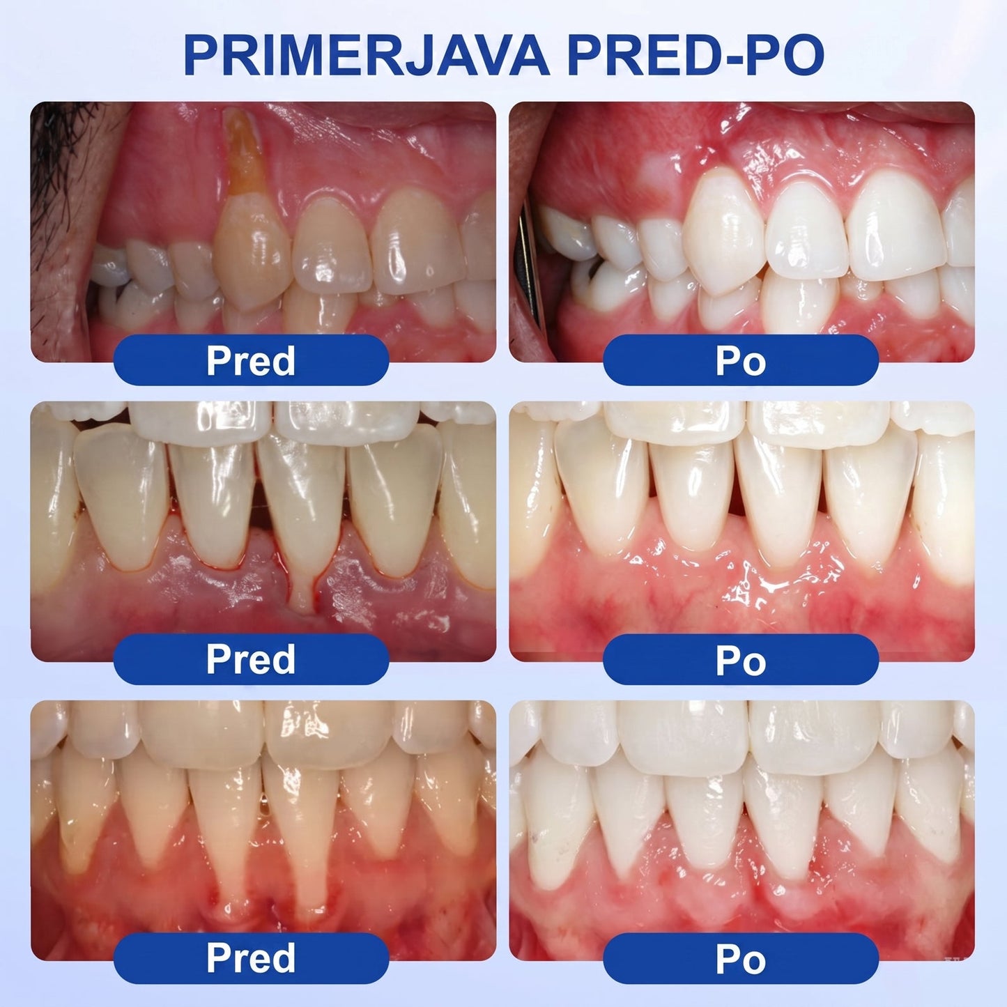 Prelomna klinična rešitev za regeneracijo ustne votline 👨‍⚕️🦷 PureShade® GumRevive regeneracijski gel za obzobna tkiva 🎁