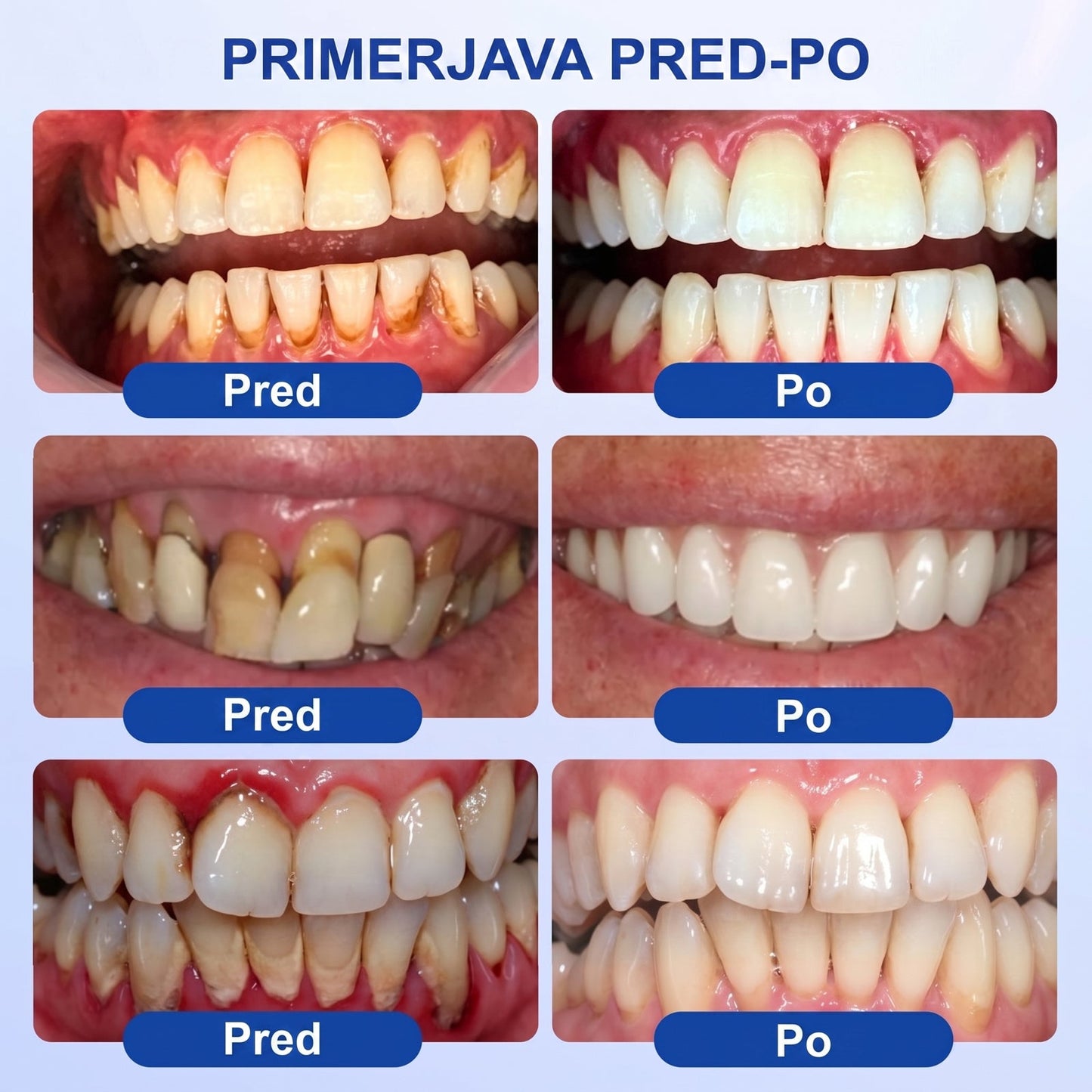 Prelomna klinična rešitev za regeneracijo ustne votline 👨‍⚕️🦷 PureShade® GumRevive regeneracijski gel za obzobna tkiva 🎁
